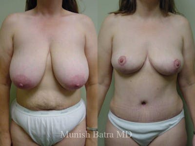 Breast Lift – Reduction Before & After Gallery - Patient 204207 - Image 1