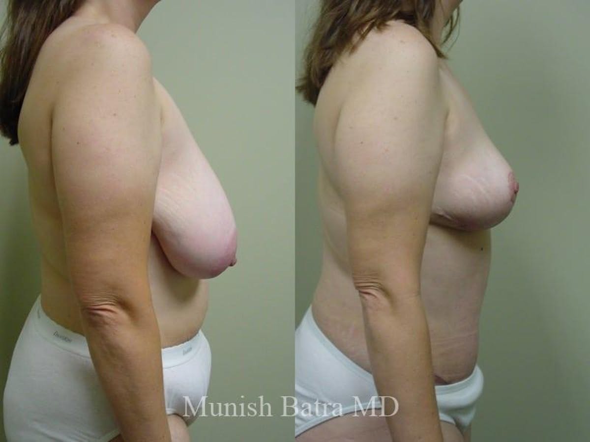 Breast Lift – Reduction Before & After Gallery - Patient 204207 - Image 2