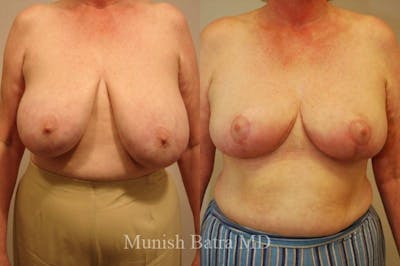 Breast Lift – Reduction Before & After Gallery - Patient 396858 - Image 1