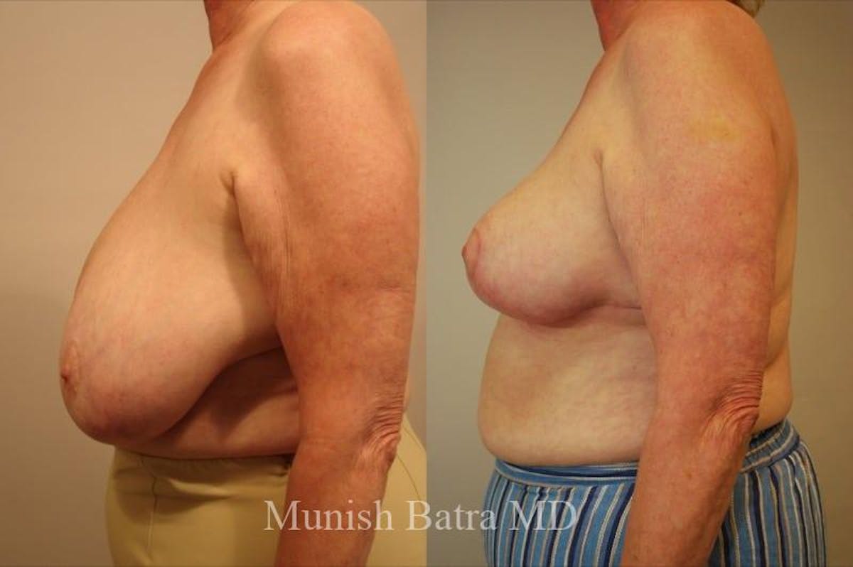 Breast Lift – Reduction Before & After Gallery - Patient 396858 - Image 2