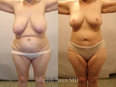 Breast Lift – Reduction Before & After Gallery - Patient 362944 - Image 1