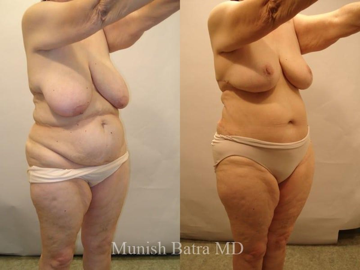 Breast Lift – Reduction Before & After Gallery - Patient 362944 - Image 2