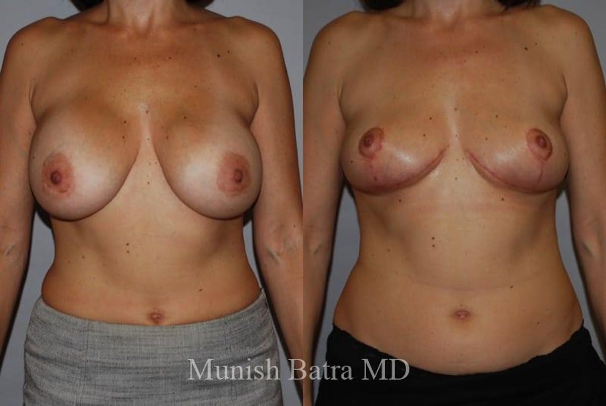 Breast Lift – Reduction Before & After Gallery - Patient 311655 - Image 1