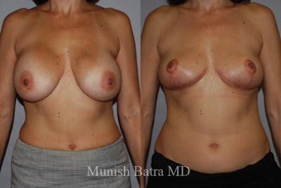 Breast Lift – Reduction Before & After Gallery - Patient 311655 - Image 1