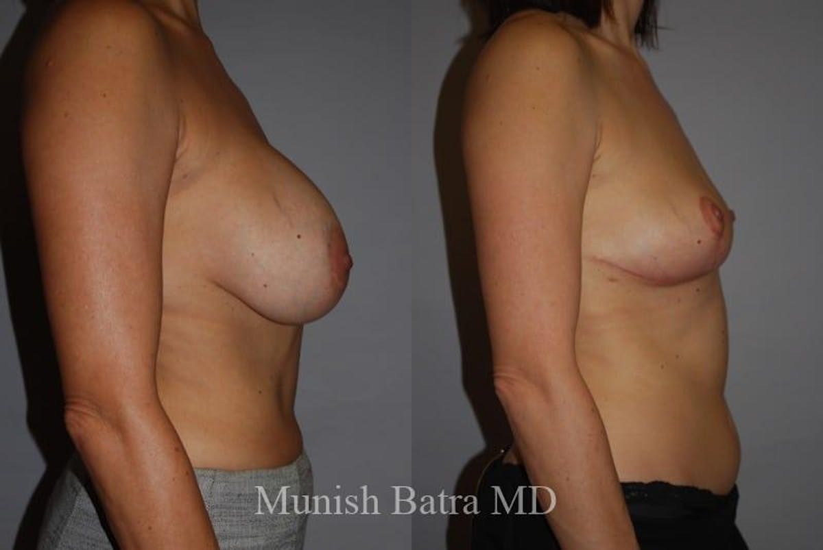 Breast Lift – Reduction Before & After Gallery - Patient 311655 - Image 2