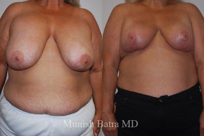 Breast Lift – Reduction Before & After Gallery - Patient 234941 - Image 1