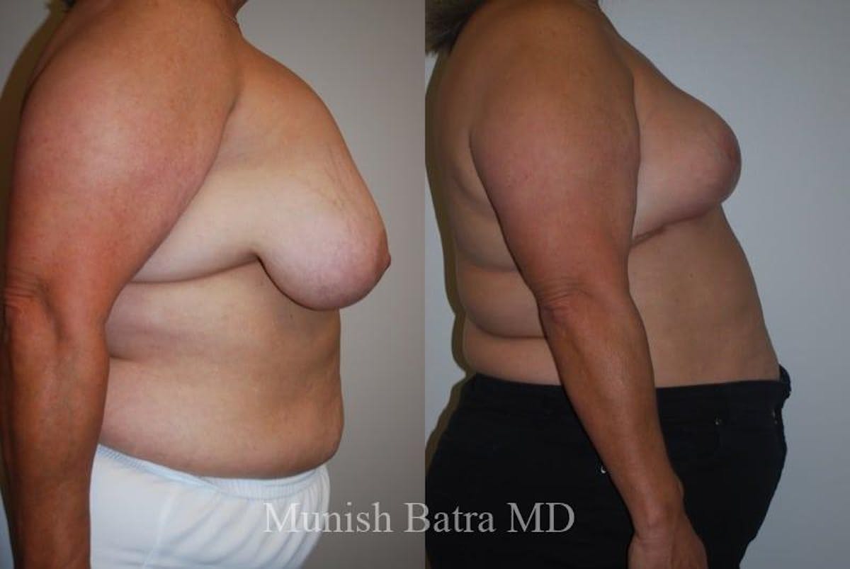 Breast Lift – Reduction Before & After Gallery - Patient 234941 - Image 2