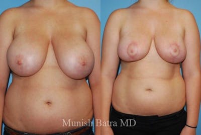 Breast Lift – Reduction Before & After Gallery - Patient 875543 - Image 1