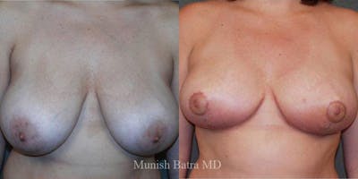 Breast Lift – Reduction Before & After Gallery - Patient 361265 - Image 1