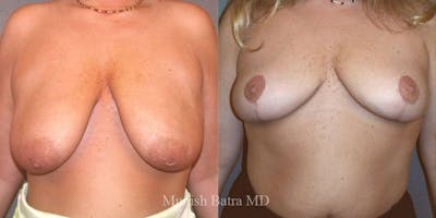 Breast Lift – Reduction Before & After Gallery - Patient 229516 - Image 1