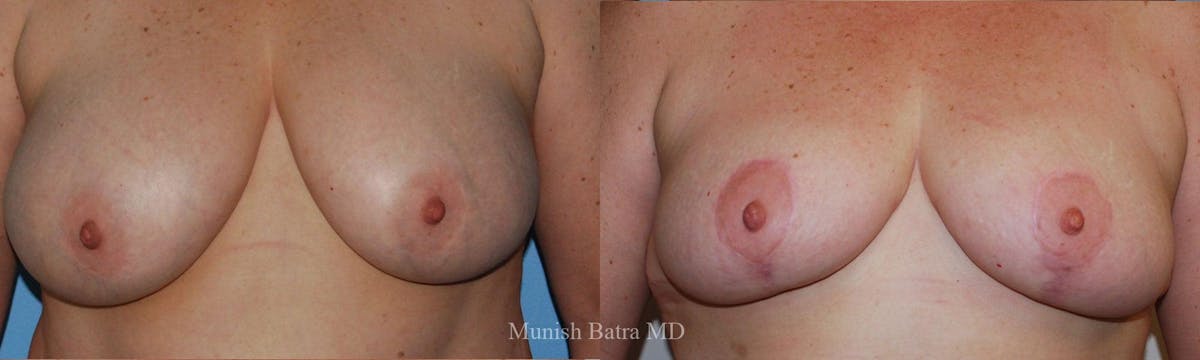 Breast Lift – Reduction Before & After Gallery - Patient 276839 - Image 1