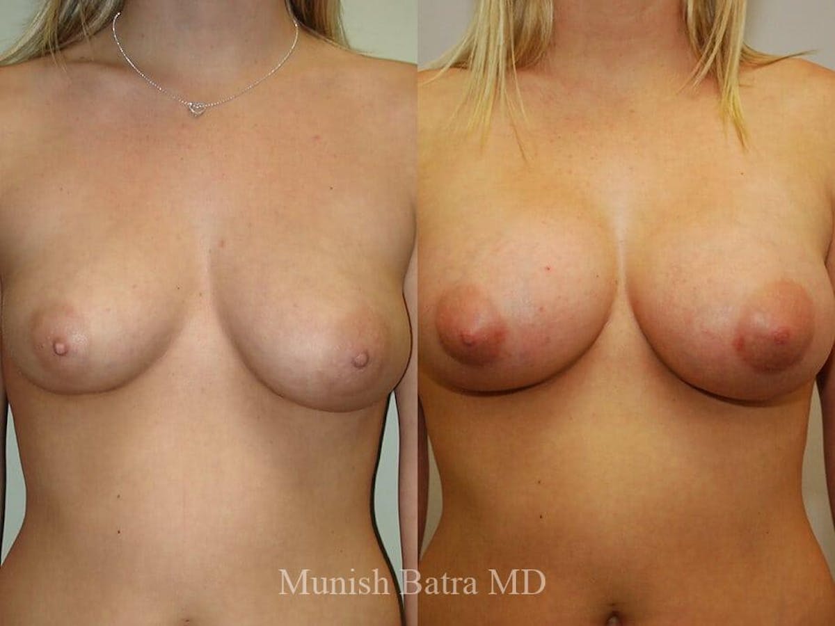 Complex Breast Before & After Gallery - Patient 133006 - Image 1