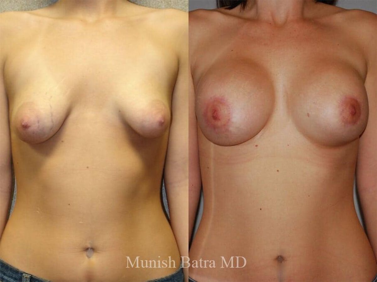 Complex Breast Before & After Gallery - Patient 378098 - Image 1