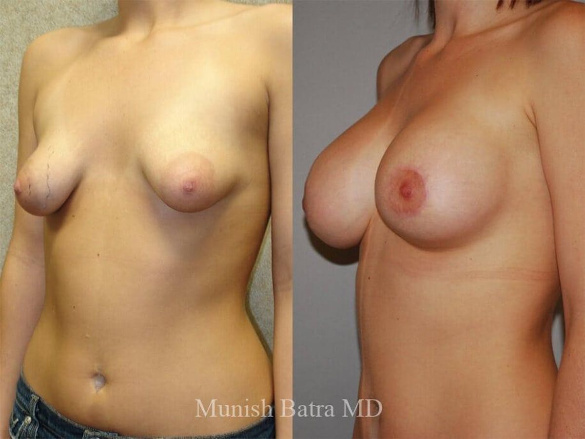 Complex Breast Before & After Gallery - Patient 378098 - Image 2
