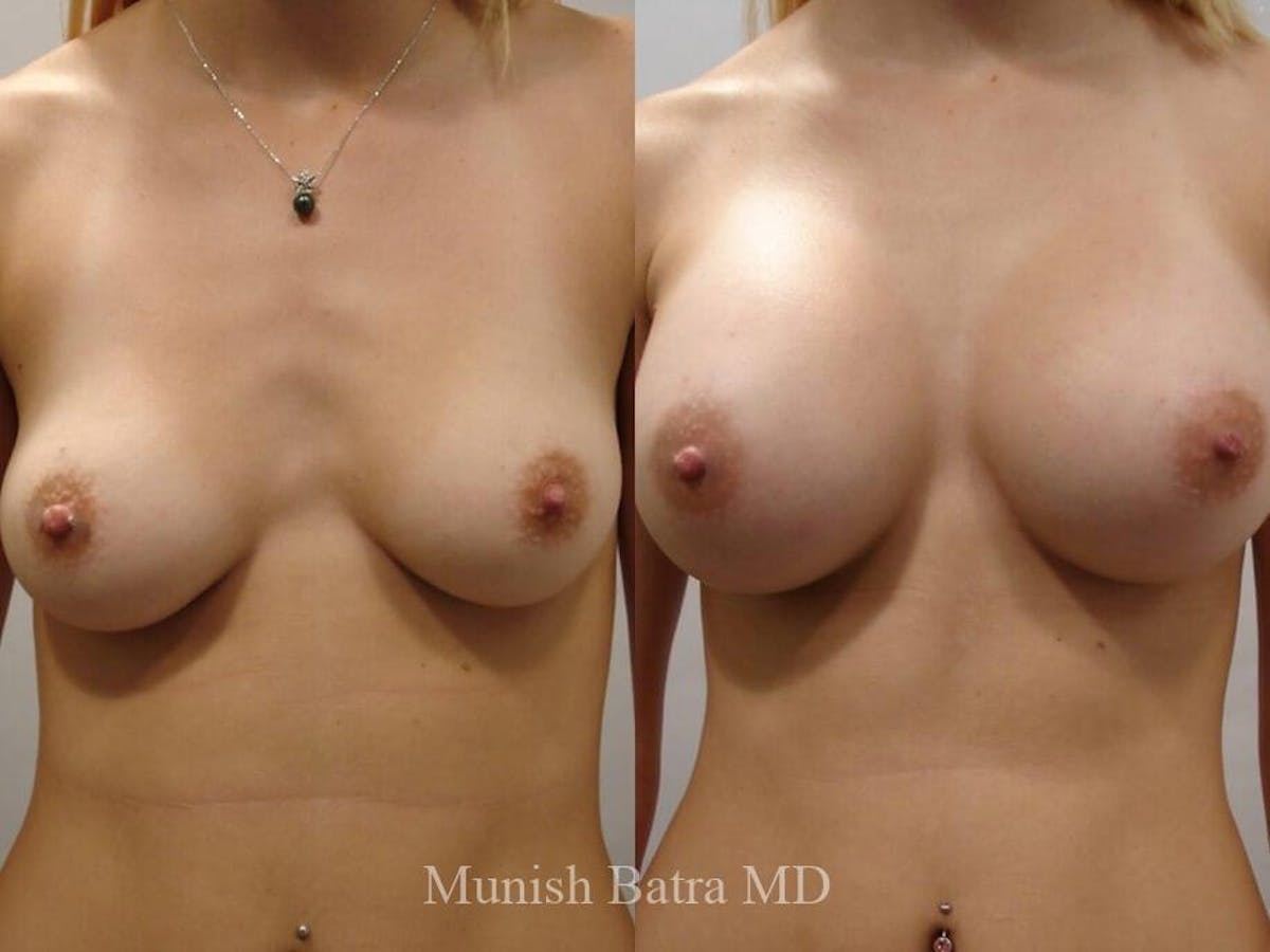 Complex Breast Before & After Gallery - Patient 127023 - Image 1
