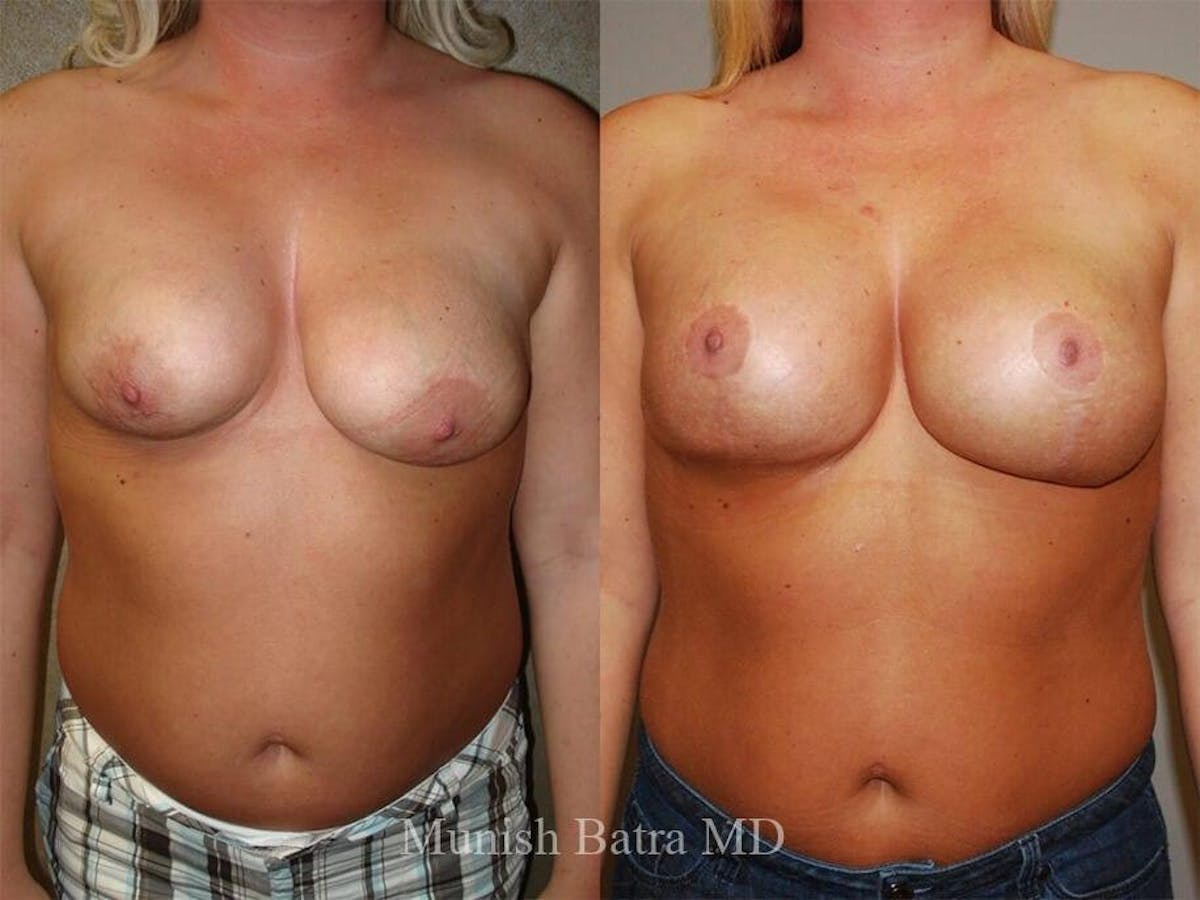Complex Breast Before & After Gallery - Patient 351716 - Image 1