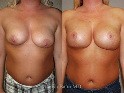 Complex Breast Before & After Gallery - Patient 351716 - Image 1