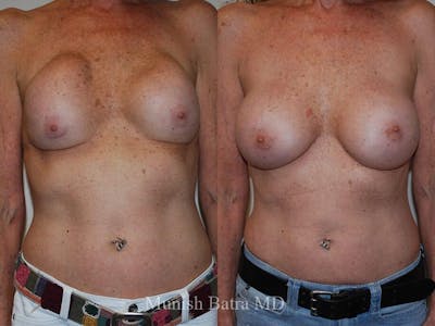 Complex Breast Before & After Gallery - Patient 400066 - Image 1