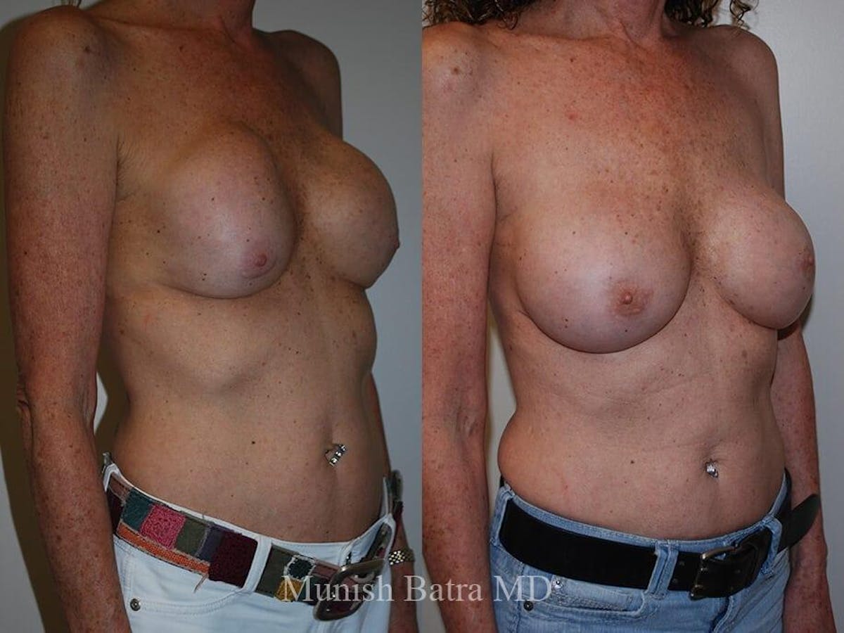 Complex Breast Before & After Gallery - Patient 400066 - Image 2