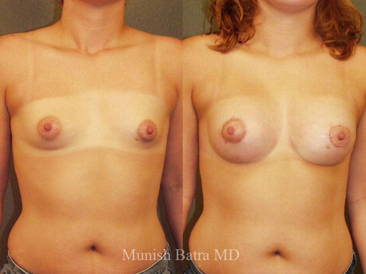 Complex Breast Before & After Gallery - Patient 546332 - Image 1