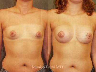 Complex Breast Before & After Gallery - Patient 546332 - Image 1