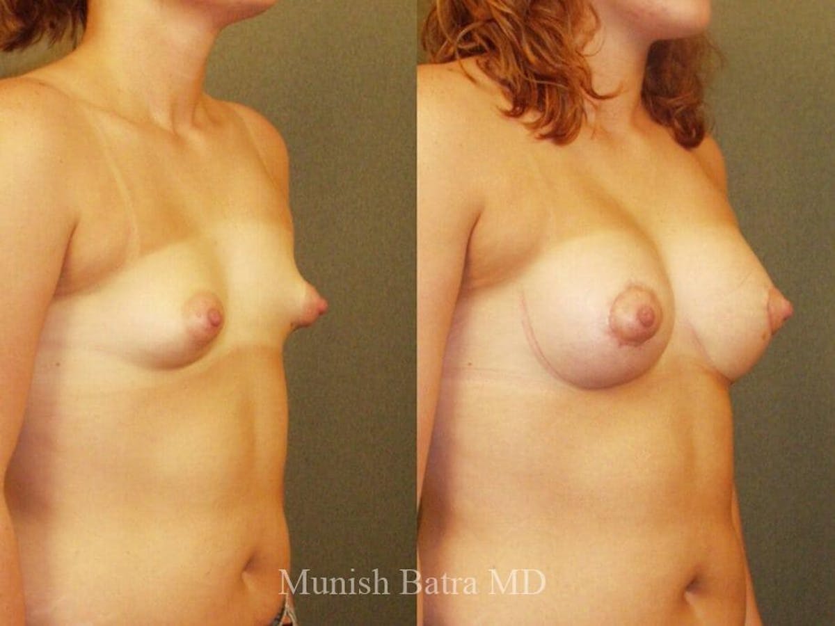 Complex Breast Before & After Gallery - Patient 546332 - Image 2