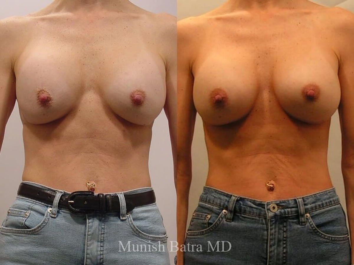 Complex Breast Before & After Gallery - Patient 716575 - Image 1