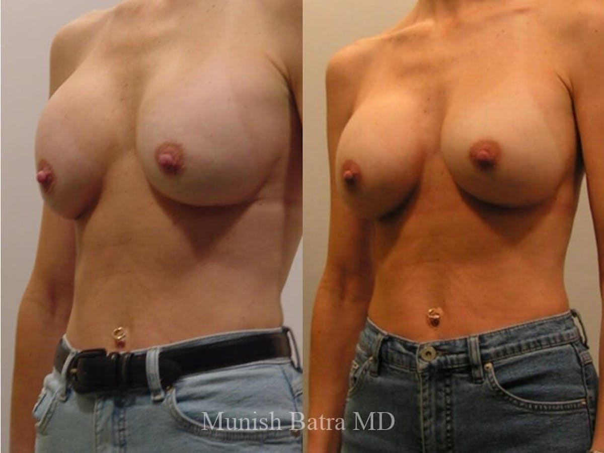 Complex Breast Before & After Gallery - Patient 716575 - Image 2