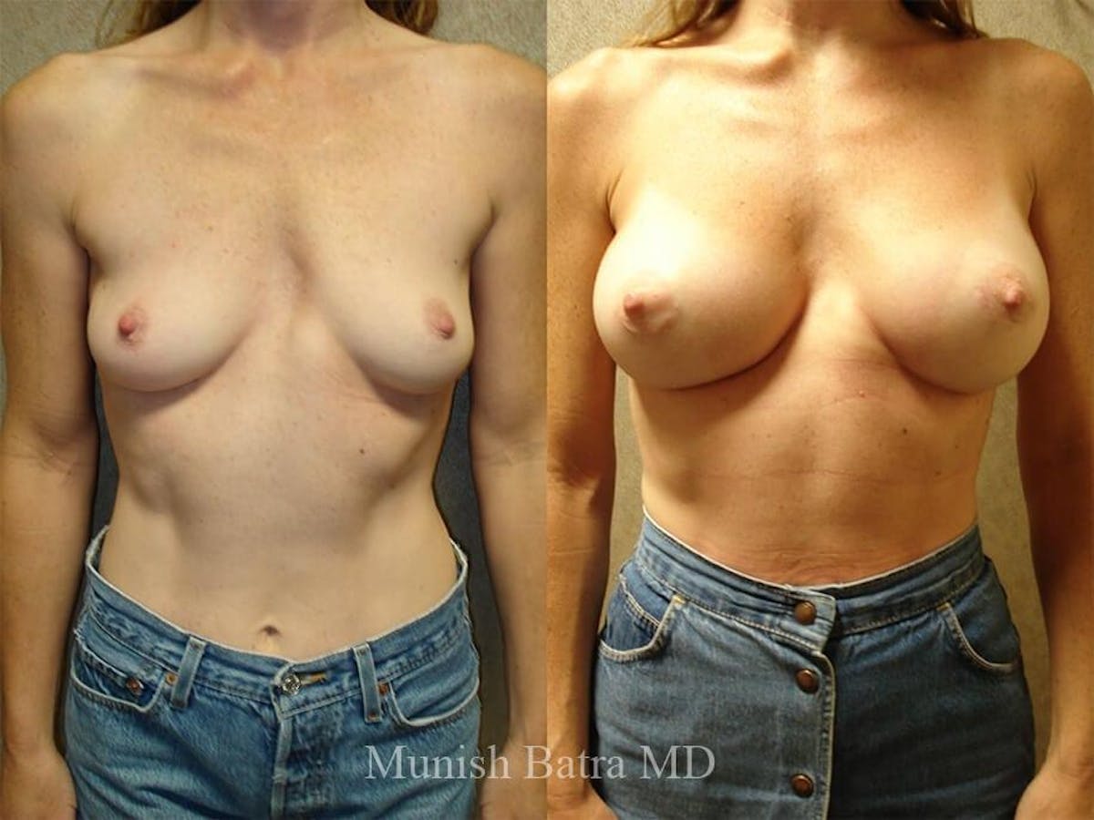 Complex Breast Before & After Gallery - Patient 366774 - Image 1