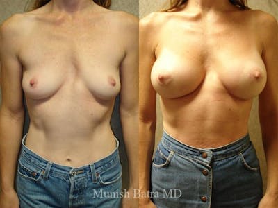 Complex Breast Before & After Gallery - Patient 366774 - Image 1