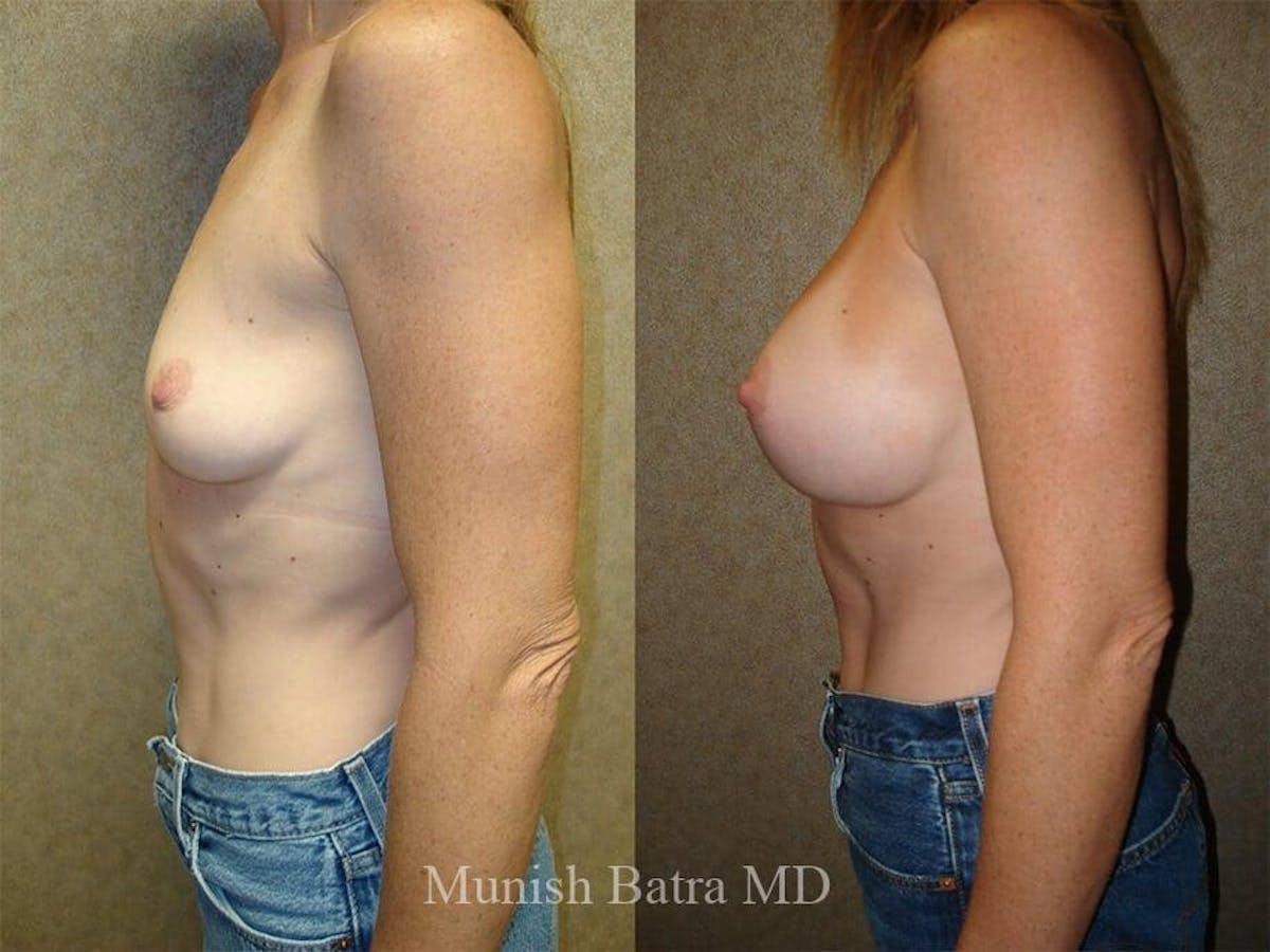 Complex Breast Before & After Gallery - Patient 366774 - Image 2