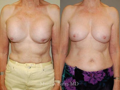Complex Breast Before & After Gallery - Patient 161462 - Image 1