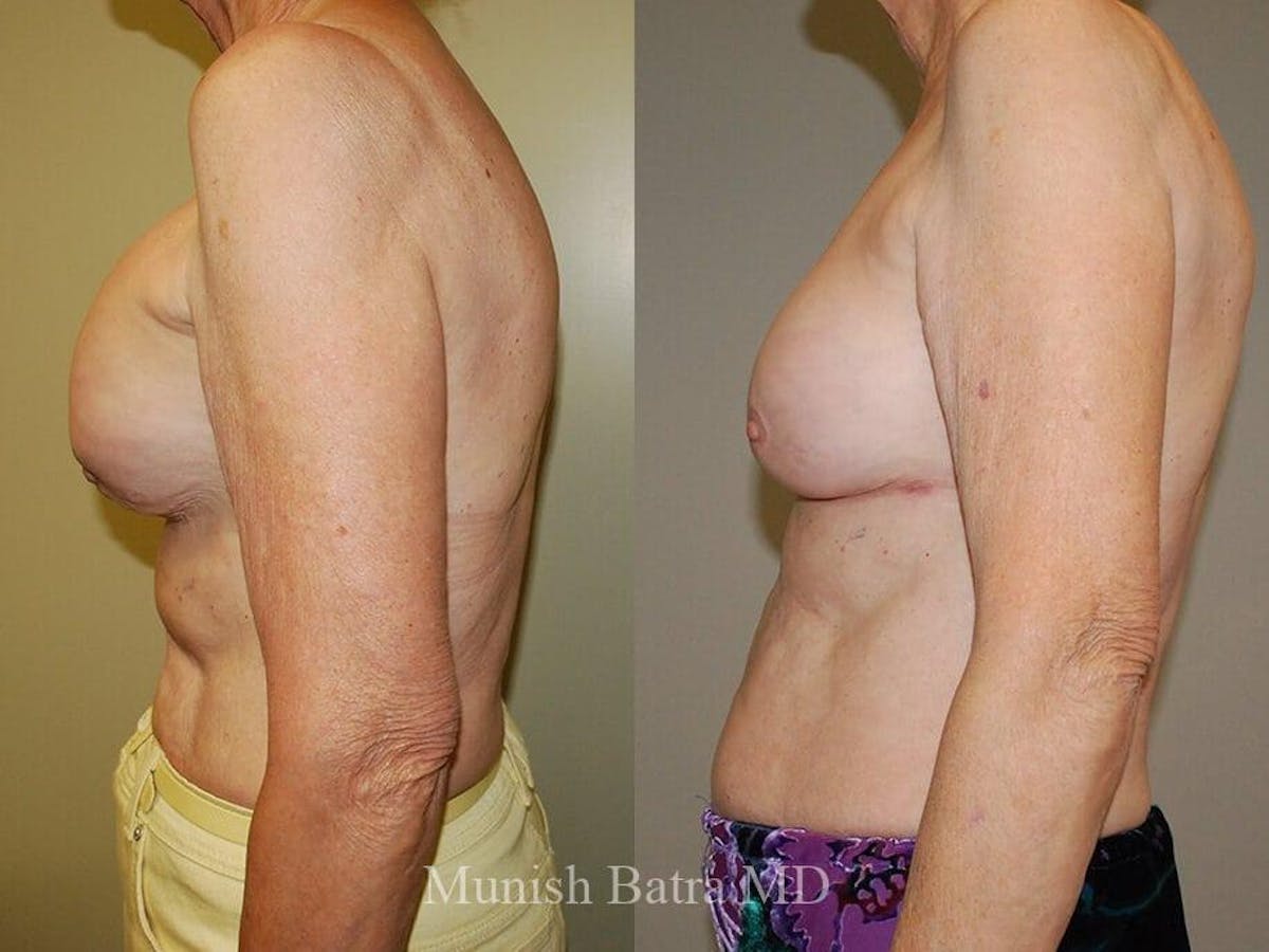 Complex Breast Before & After Gallery - Patient 161462 - Image 2