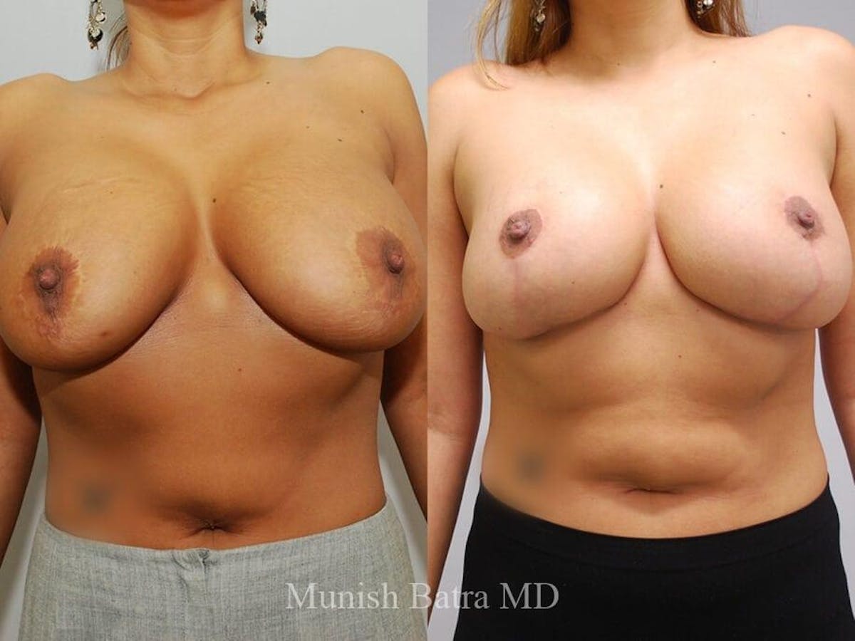 Complex Breast Before & After Gallery - Patient 530340 - Image 1