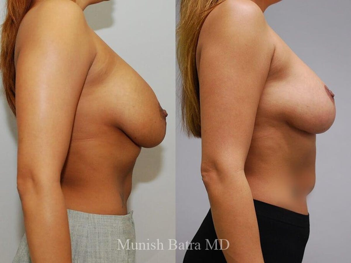 Complex Breast Before & After Gallery - Patient 530340 - Image 2