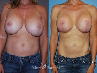 Complex Breast Before & After Gallery - Patient 594452 - Image 1