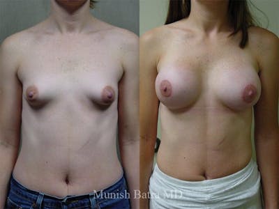 Complex Breast Before & After Gallery - Patient 399696 - Image 1
