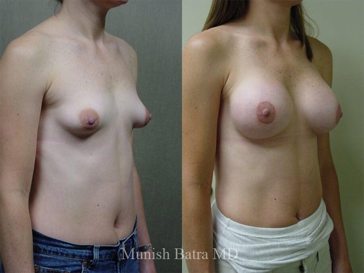 Complex Breast Before & After Gallery - Patient 399696 - Image 2