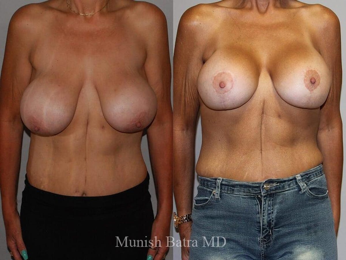 Complex Breast Before & After Gallery - Patient 341227 - Image 1