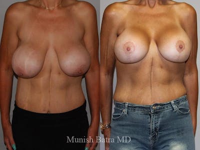 Complex Breast Before & After Gallery - Patient 341227 - Image 1