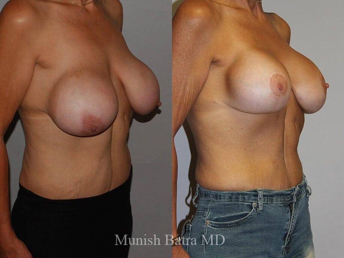 Complex Breast Before & After Gallery - Patient 341227 - Image 2