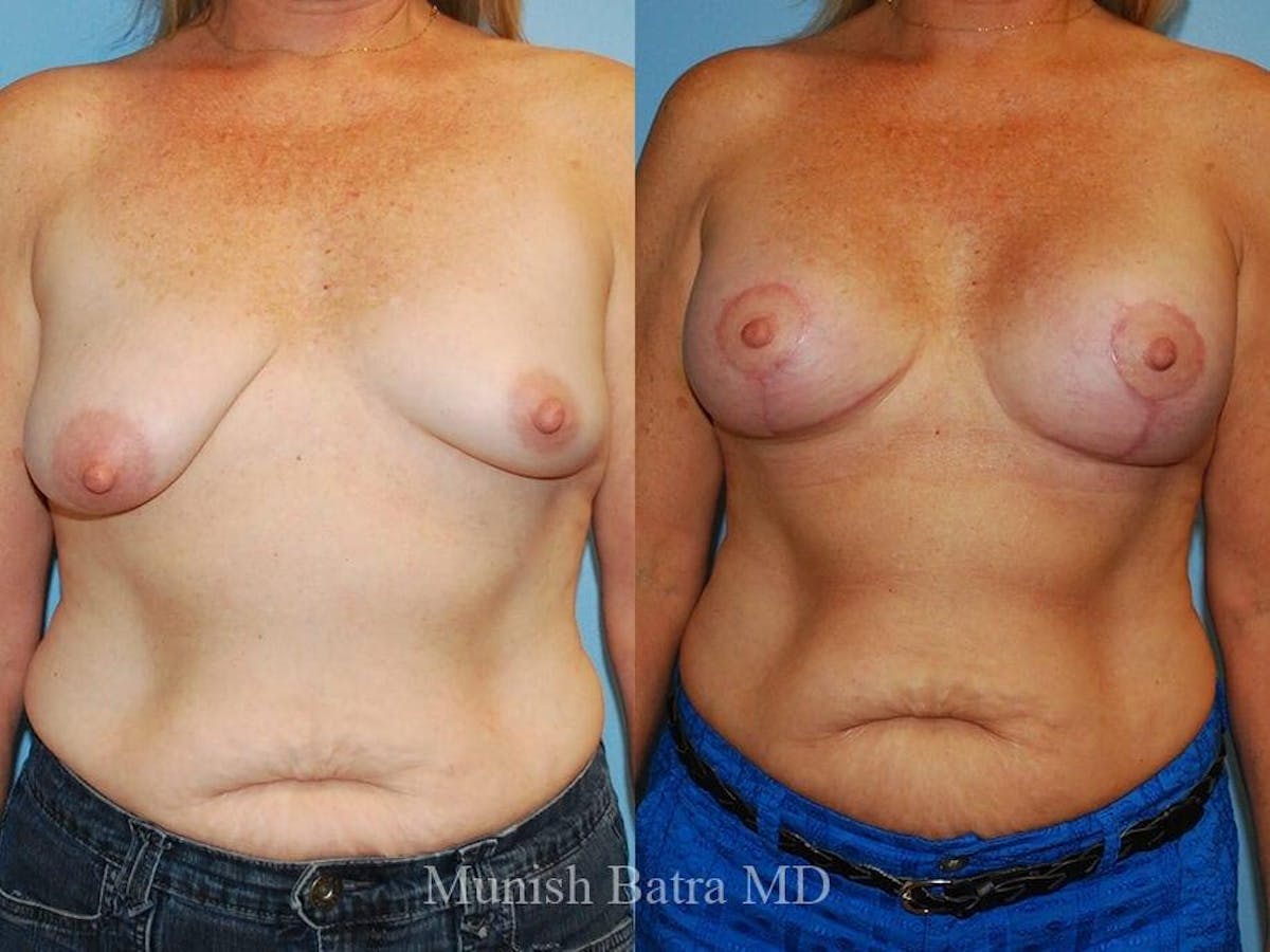Complex Breast Before & After Gallery - Patient 322592 - Image 1