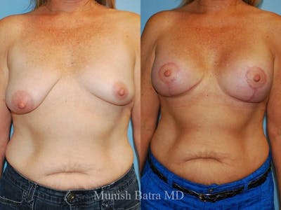 Complex Breast Before & After Gallery - Patient 322592 - Image 1
