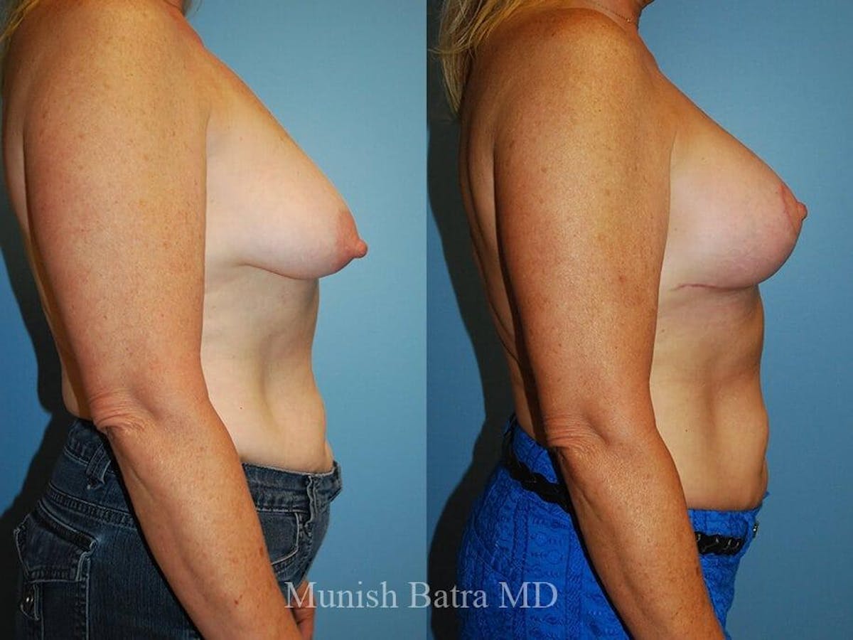 Complex Breast Before & After Gallery - Patient 322592 - Image 2