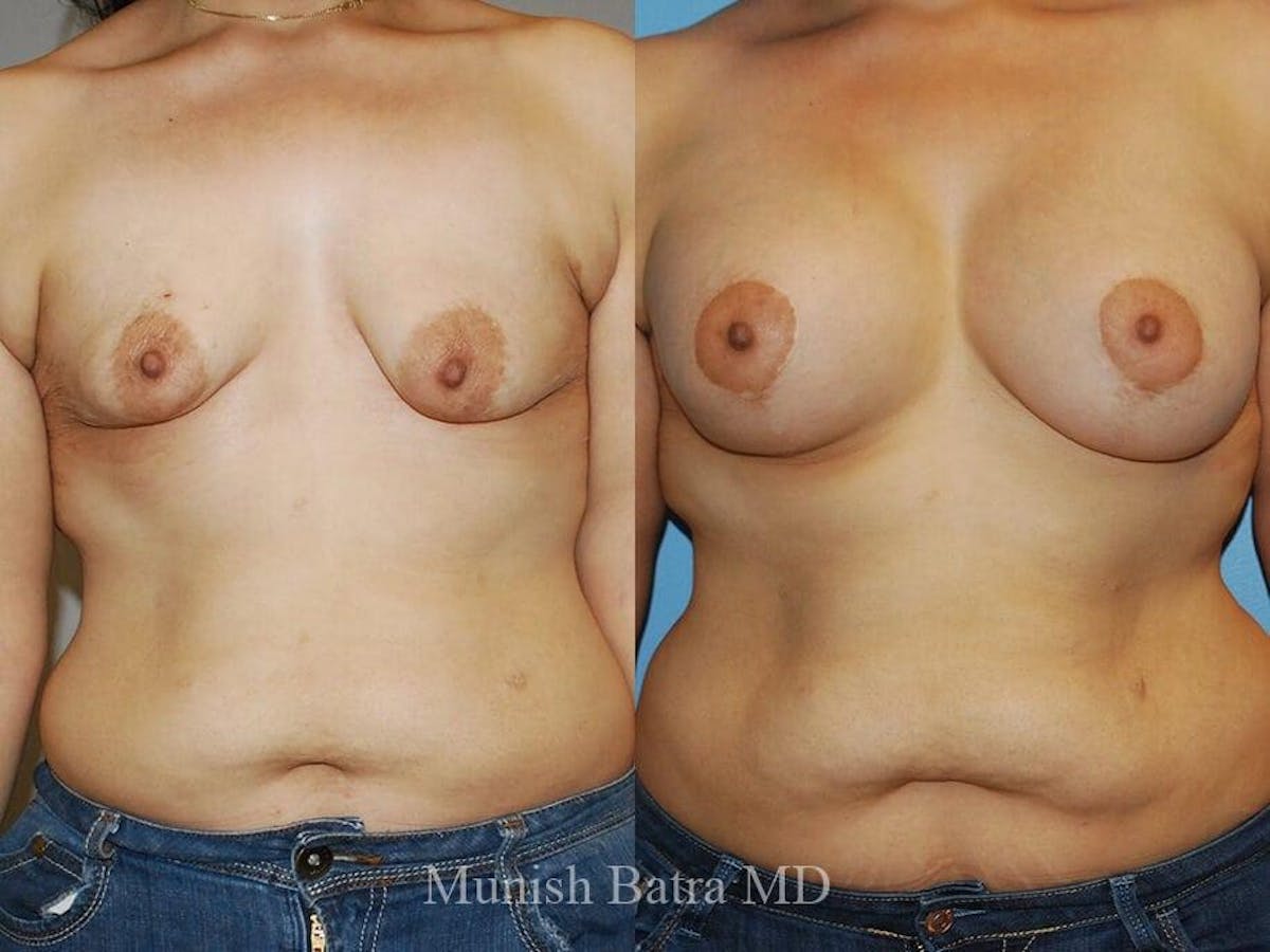 Complex Breast Before & After Gallery - Patient 510139 - Image 1