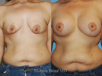 Complex Breast Before & After Gallery - Patient 510139 - Image 1