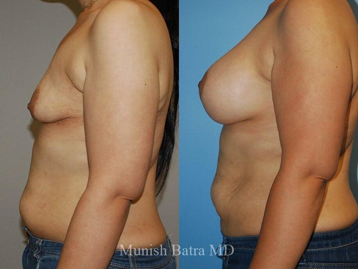 Complex Breast Before & After Gallery - Patient 510139 - Image 2