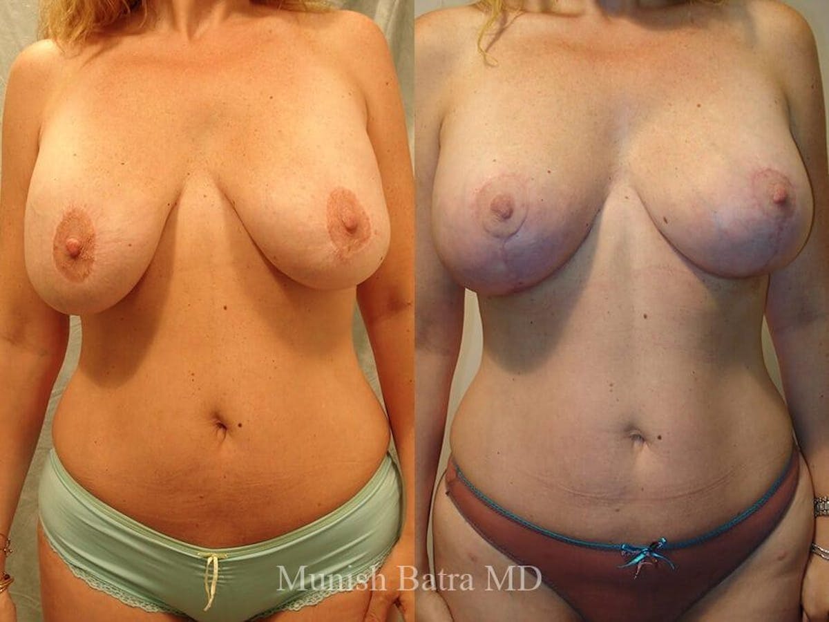 Complex Breast Before & After Gallery - Patient 381875 - Image 1