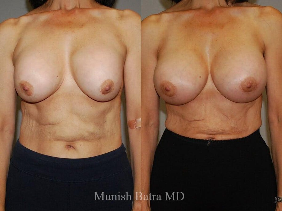 Complex Breast Before & After Gallery - Patient 132715 - Image 1