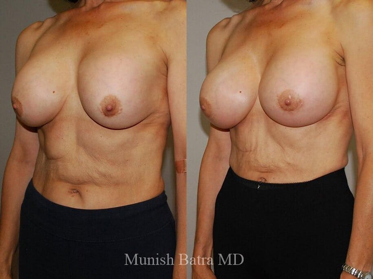 Complex Breast Before & After Gallery - Patient 132715 - Image 2